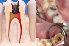 Viêm tủy răng là nguyên nhân chủ yếu gây nhiễm trùng răng