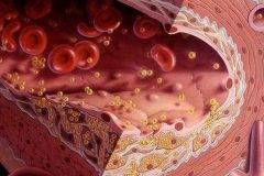 Bệnh mỡ máu là gì có nguy hiểm không?