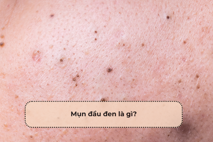 Yoosun Acnes có trị mụn đầu đen không?