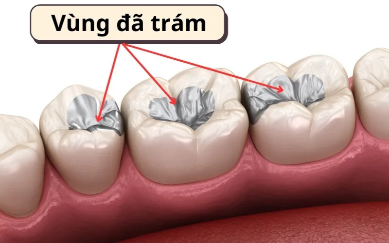 Inlay/Onlay sẽ trám khít răng không gây sâu răng, độ bền, thẩm mỹ cao