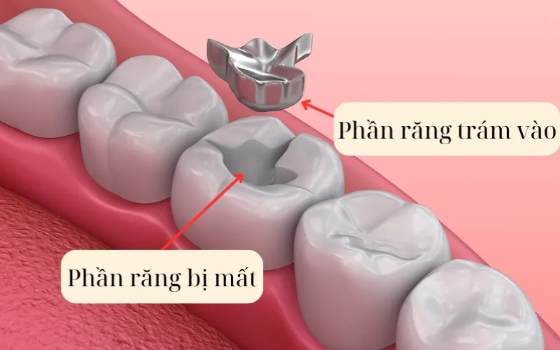 Bác sĩ sẽ lấy dấu răng và thiết kế khít với răng bằng công nghệ cao