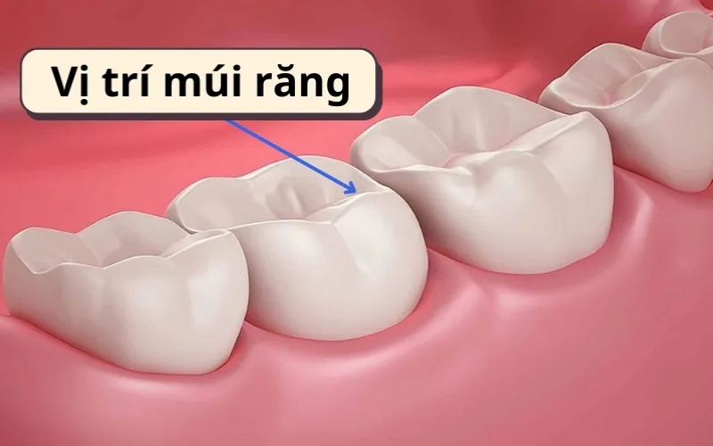 Vị trí múi răng, nếu mất đi sẽ thực hiện phương pháp Onlay