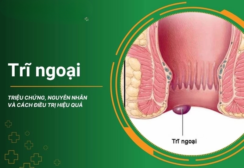 Trĩ ngoại là gì?