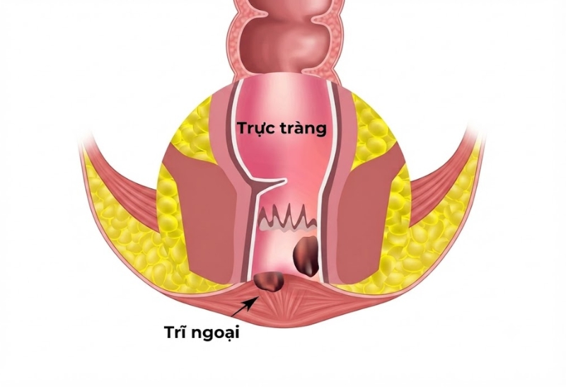 Khi nào búi trĩ ngoại có thể nhỏ lại?