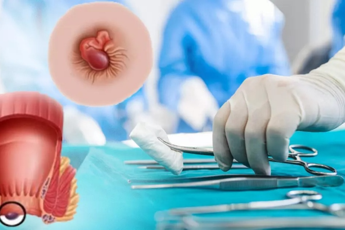 Phẫu thuật cắt trĩ được sử dụng khi các biện pháp khác không hiệu quả