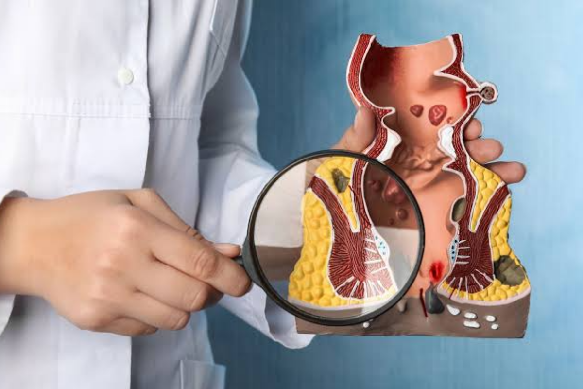 Thắt búi trĩ bằng vòng cao su là phương pháp điều trị quen thuộc