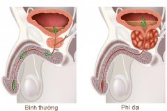 Quan hệ tình dục ở người bị phì đại tuyến tiền liệt