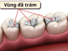 Inlay/Onlay sẽ trám khít răng không gây sâu răng, độ bền, thẩm mỹ cao