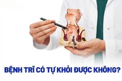 Bệnh trĩ ngoại có tự co lên không? Giải đáp từ chuyên gia