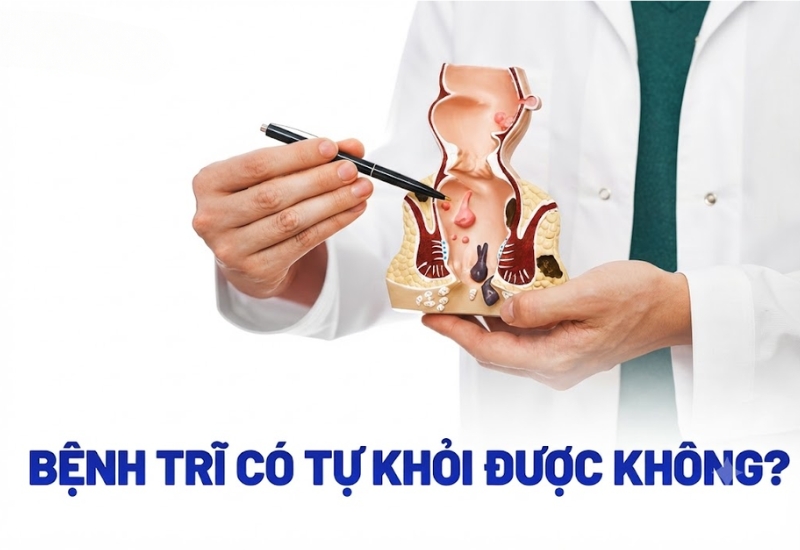 Bệnh trĩ ngoại có tự co lên không? Giải đáp từ chuyên gia