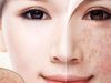 3 cách trị nám da an toàn và hiệu quả với khoai tây