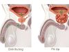 Quan hệ tình dục ở người bị phì đại tuyến tiền liệt