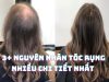 3+ nguyên nhân tóc rụng nhiều chi tiết đầy đủ nhất