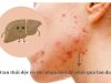 Da bị xấu đi có phải do gan đang thải độc không? 