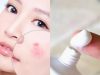 Top 5 cách trị mụn nhanh nhất mà bạn nên thử ngay